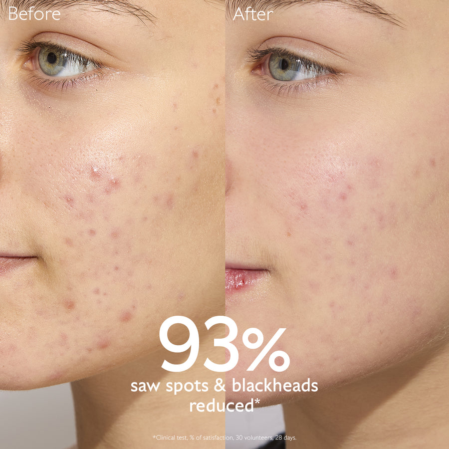 before-after-comparison-using-vinopure-lotion