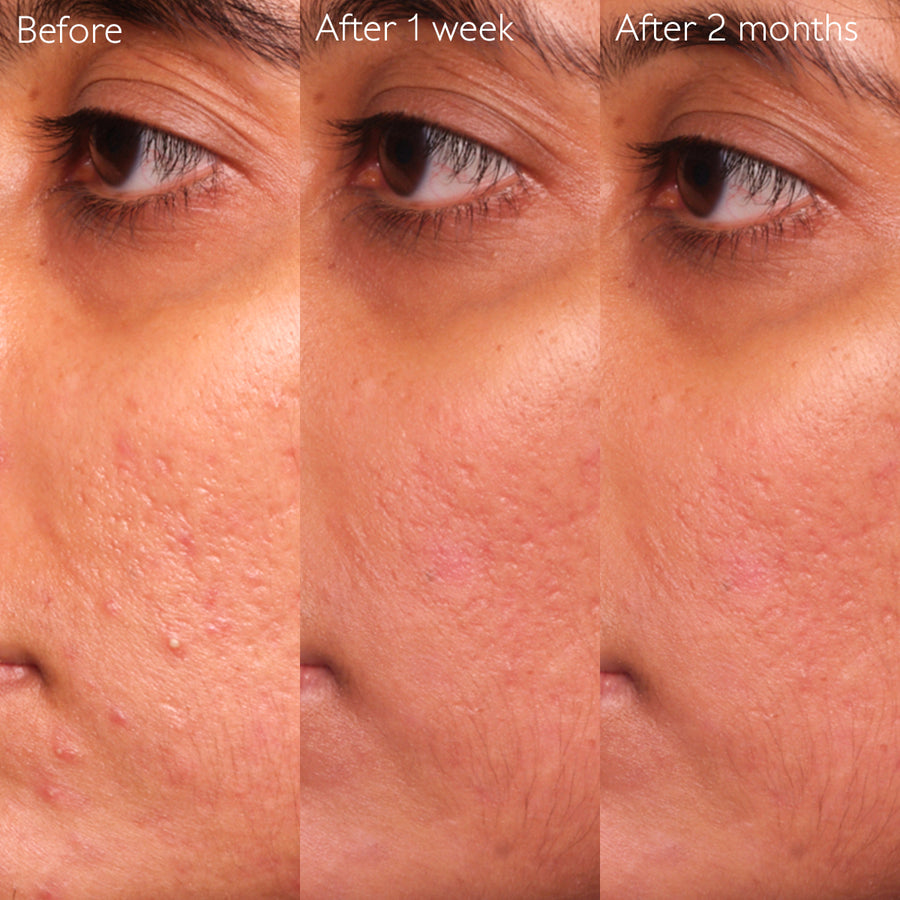vinopure-serum-before-after-using