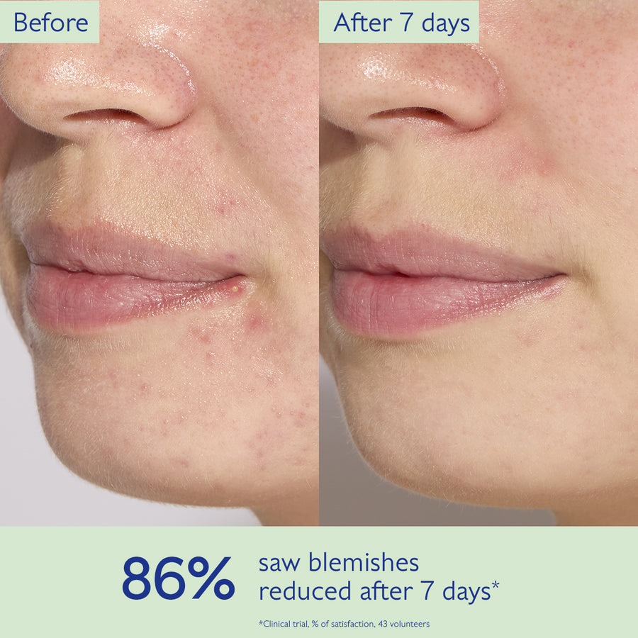 Vinopure  Blemish Control Salicylic Acid Serum